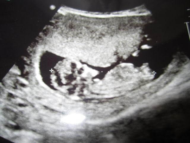 Плод 11 недель фото. УЗИ 11 недель беременности. УЗИ плода на 11 неделе беременности. Зародыш 11 недель УЗИ. Эмбрион на 11 неделе беременности УЗИ.